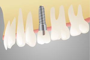 Implantat - Zahnarzt Wilmersdorf - hochwertiger Zahnersatz